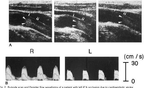 Figure 2 From Cardioembolic Carotid Artery Occlusion Acute Unilateral