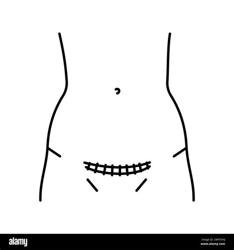 Pfannenstiel incision line icon. Abdominal incisions. Vector isolated ...