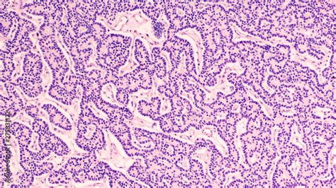 Microscopic image showing histology of a parathyroid adenoma, a benign tumor which releases ...