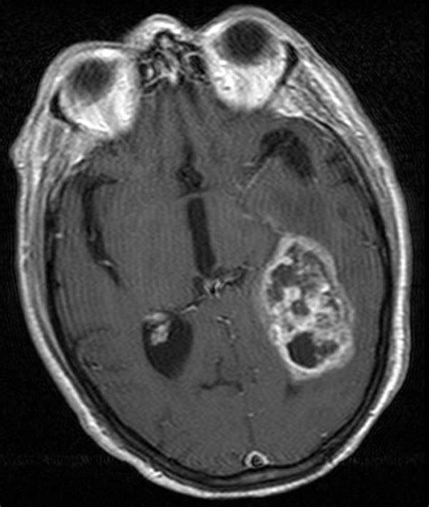 Pin on Glioblastoma multiforme 4