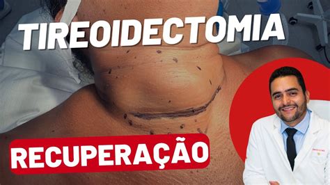 Tireoidectomia O que Esperar Antes Durante e Após a Cirurgia YouTube