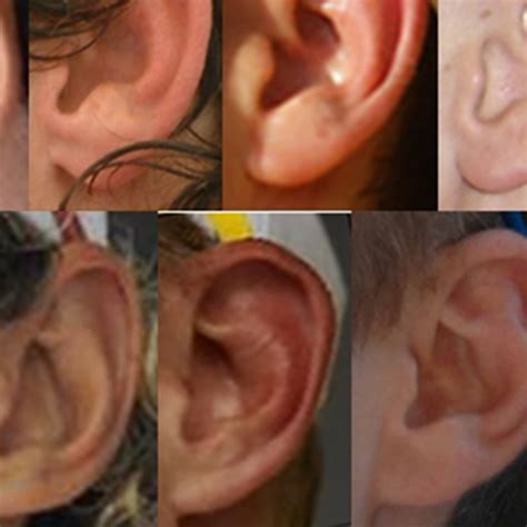 Unattached Earlobes Dominant Or Recessive