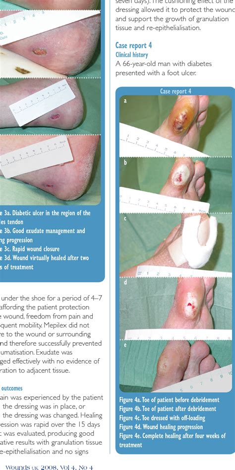 Figure 4 From Management Of Diabetic Foot Ulcers Using Dressings With Safetac ® A Review Of