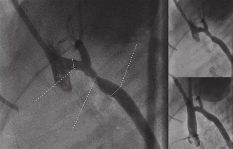 Aortic coarctation (AoC) treated with angioplasty and implantation of a ...