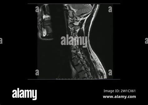 Magnetic Resonance images of Cervical spine sagittal T2-weighted images ...