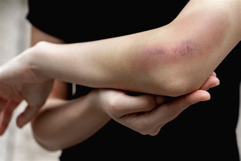 What Are Serious Bruises And How Can I Treat Them Performance Health