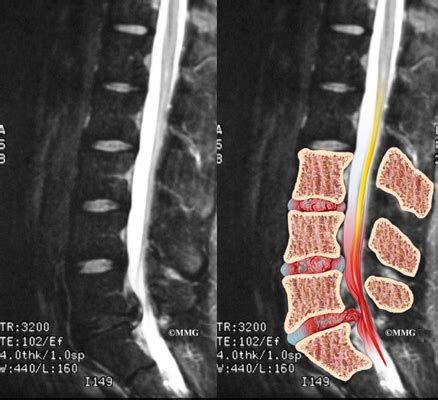 Lumbar Disc Herniation - eOrthopod.com