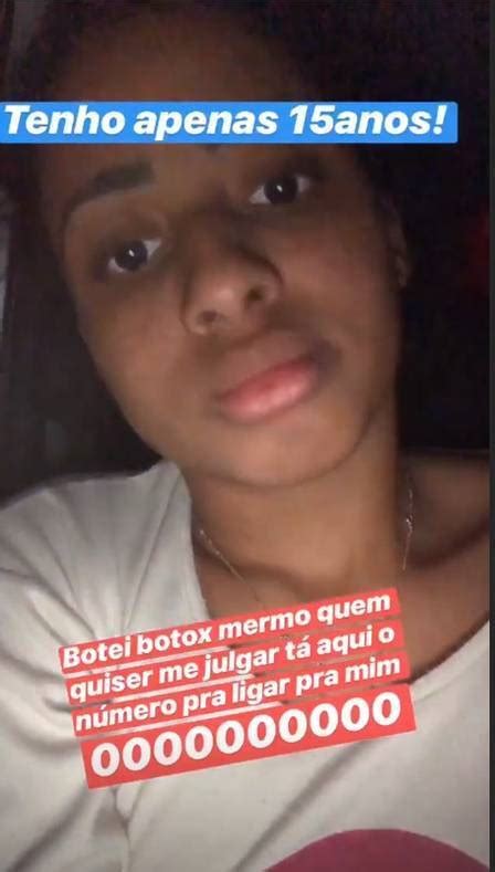 Aos 15 Anos MC Loma Aplica Botox E Mostra O Resultado