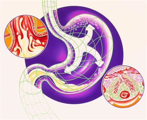 Artwork Showing Dyspepsia & Acid Reflux Treatment Photograph by John Bavosi - Pixels