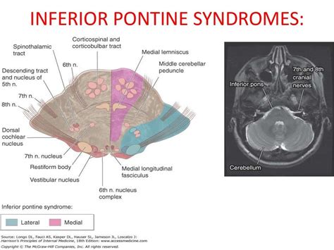 Anatomy Of Brainstem And Its Clinical Significance Artofit