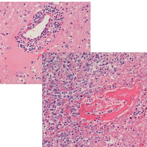 Microscopic Findings Hematoxylin Eosin Coloring Magnification 200x