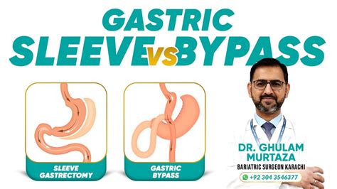 Sleeve Gastrectomy Vs Gastric Bypass Which One Is Right For You