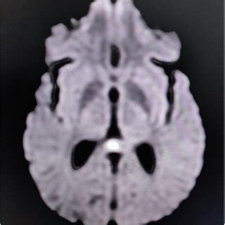 Axial diffusion-weighted MRI showing low-diffusion signal arising from ...