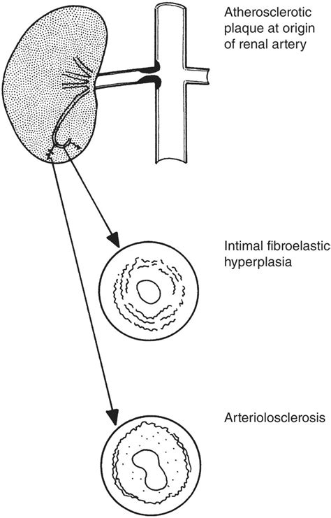 Kidney And Ureter Vascular Disorders Abdominal Key