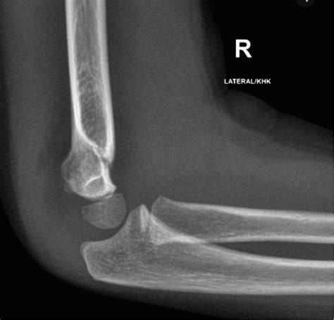 Supracondylar Fractures Maimonides Emergency Medicine Residency