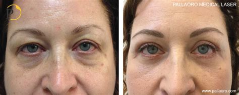 Foto Prima E Dopo Della Blefaroplastica Completa Pallaoro Medical Laser