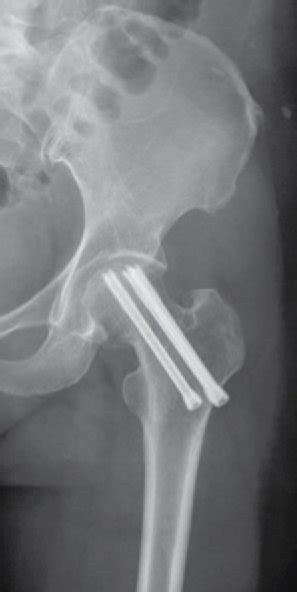 Typical Radiographs With Nonunion Of Vertical Femoral Neck Fractures