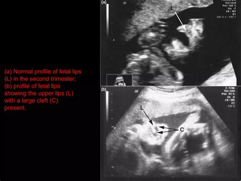 5 Fetal Face Ultrasound Dr Ahmed Esawy Ppt