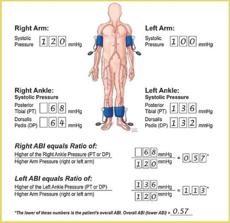 20 Best Ankle Brachial Index Chart