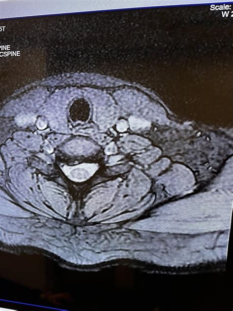 Recent Cervical MRI : r/SpinalStenosis