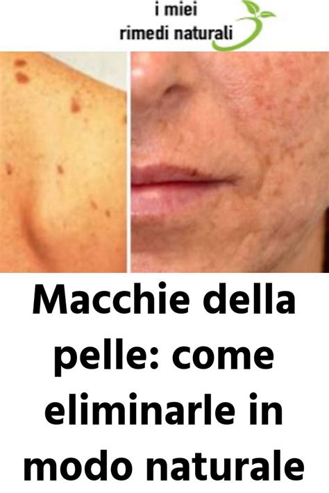 Macchie Della Pelle Come Eliminarle In Modo Naturale Medicine