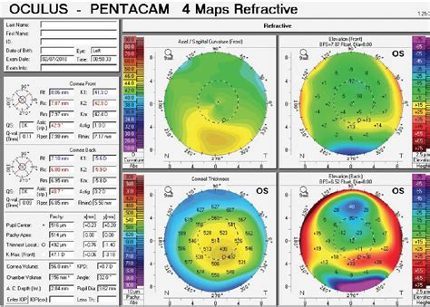 Crstoday Does This Patient Have Keratoconus