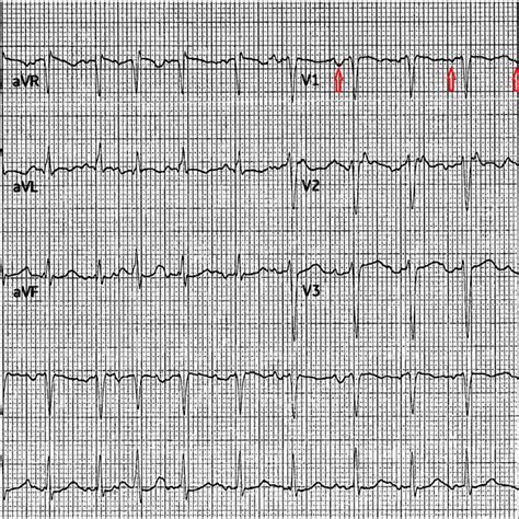 Twelve Lead Electrocardiogram Of Multifocal Atrial Tachycardia With P