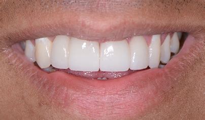 Dental Crowns Before And After