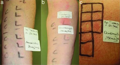 Case 1. (a) A 24-h reading with positive intradermal test results with ...