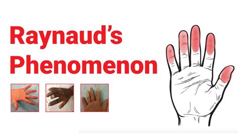 Raynaud's Phenomenon : What You Should Know - Johns Hopkins RheumTV