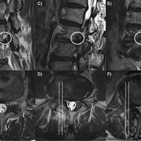 Radiologic Foraminal Stenosis Zone Using A T2 Weighted Magnetic