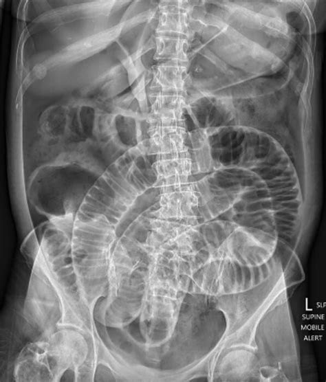 Rigler Sign And Hepatic Portal Venous Gas Classic Surgical Radiology