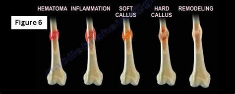 Stages Of Fracture Healing - Speeding Up Bone Fracture Healing part 2 ...