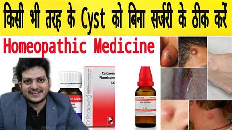 Cyst Homeopathic Medicine For All Type Of Cyst Remove 100 Youtube