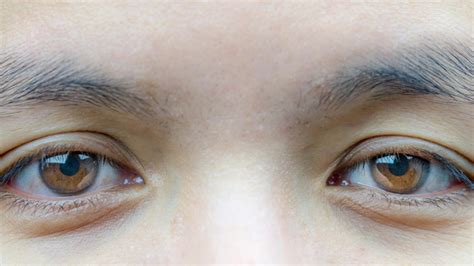 8 Causes of Ptosis and What You Can Do About It