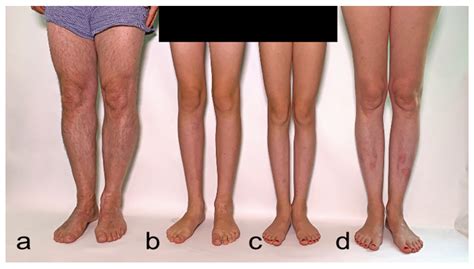 Second Degree Burn Healing Process Pictures