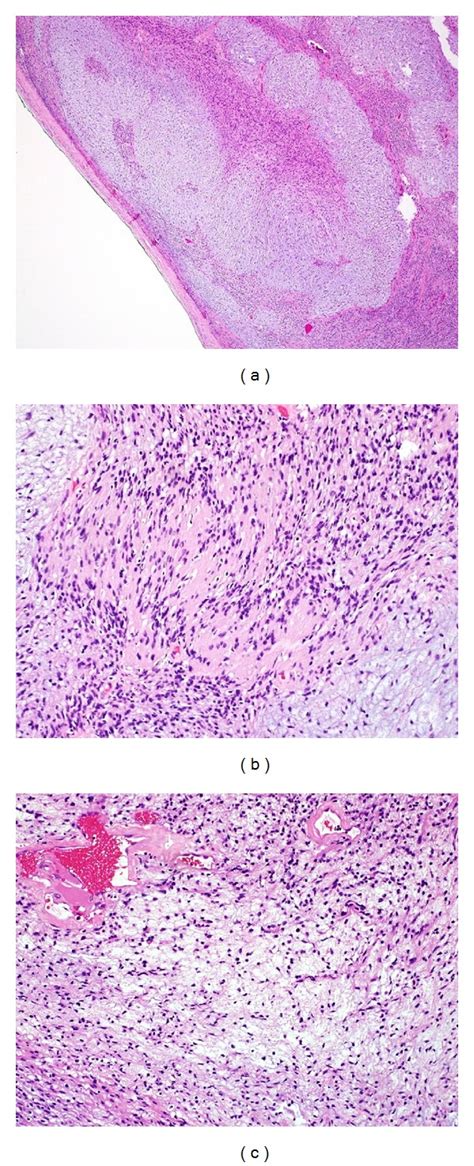 Microscopic Examination Of Pleural Mass Hematoxylin And Eosin Hande