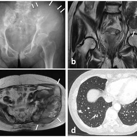 Case Sacrum Aneurysmal Bone Cyst A B Plain Radiographs And D Ct