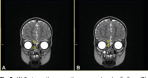 Figure 1 From Dermoid Cyst Of Nasal Tip With A Sinus Tract Extending To