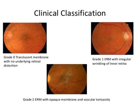 Ophthalmology Notes Epiretinal Membrane Erm Grading