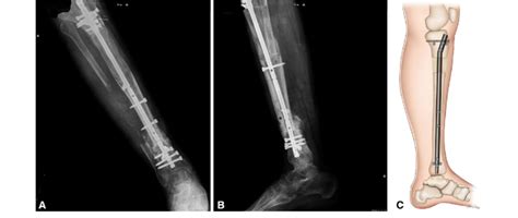 A-C Radiographic images and drawing of the tibia at 5 months followup ...