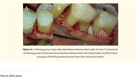 Table From The Validity Of Intramarrow Penetration With Open Flap