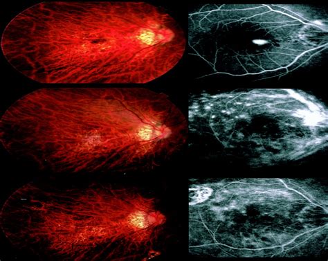 VITREOMACULAR TRACTION AFTER MACULAR TRANSLOCATION SURGERY I RETINA