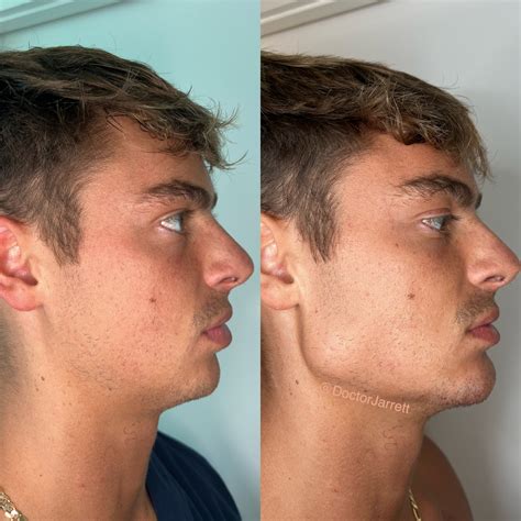 Facial Balancing Designer Aesthetics By Dr Jarrett Schanzer Miami