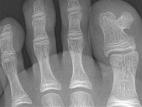 Osteochondroma And Multiple Hereditary Exostosis Pathology Orthobullets