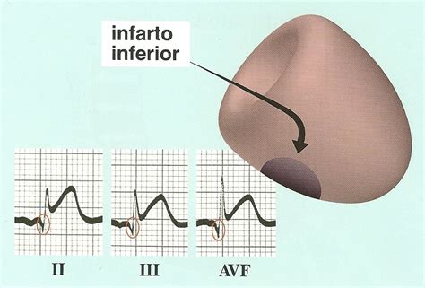 Dr Rafael Soto Electrocardiografía Cardiología Clínica Infarto