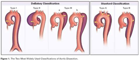 Cardiology - Diseases of the Aorta Flashcards | Quizlet