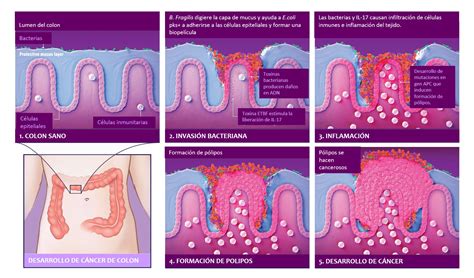 Bacterias Cancer Colon Genotipia