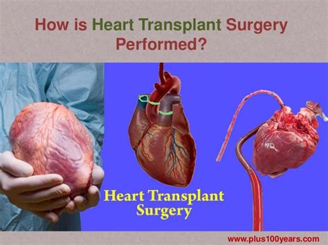 How is heart transplant surgery performed?