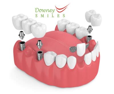 Dental Bridges Types Cost Advantages Procedure Best Smiles Dental